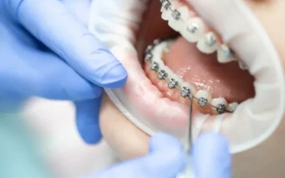 Orthodontiste à Esch-sur-Alzette : pourquoi l’orthodontie précoce est cruciale pour la santé dentaire des enfants ?