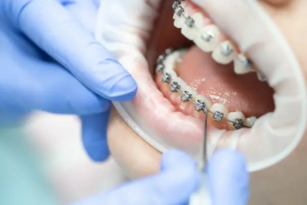 Orthodontiste à Esch-sur-Alzette : pourquoi l’orthodontie précoce est cruciale pour la santé dentaire des enfants ?